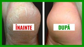 Cum să-ți îngrijești călcâiele uscate și crăpate. 4 remedii pe care le poți încerca acasă
